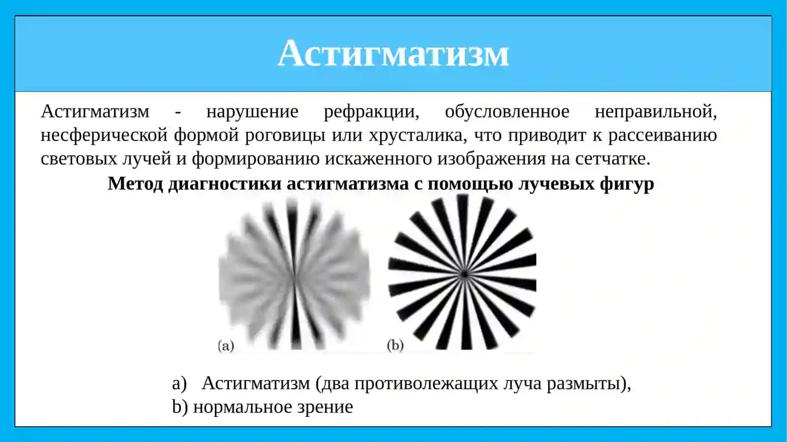 АСТИГМАТИЗМ.ВИДЫ АСТИГМАТИЗМА. КОРРЕКЦИЯ АСТИГМАТИЗМА 3