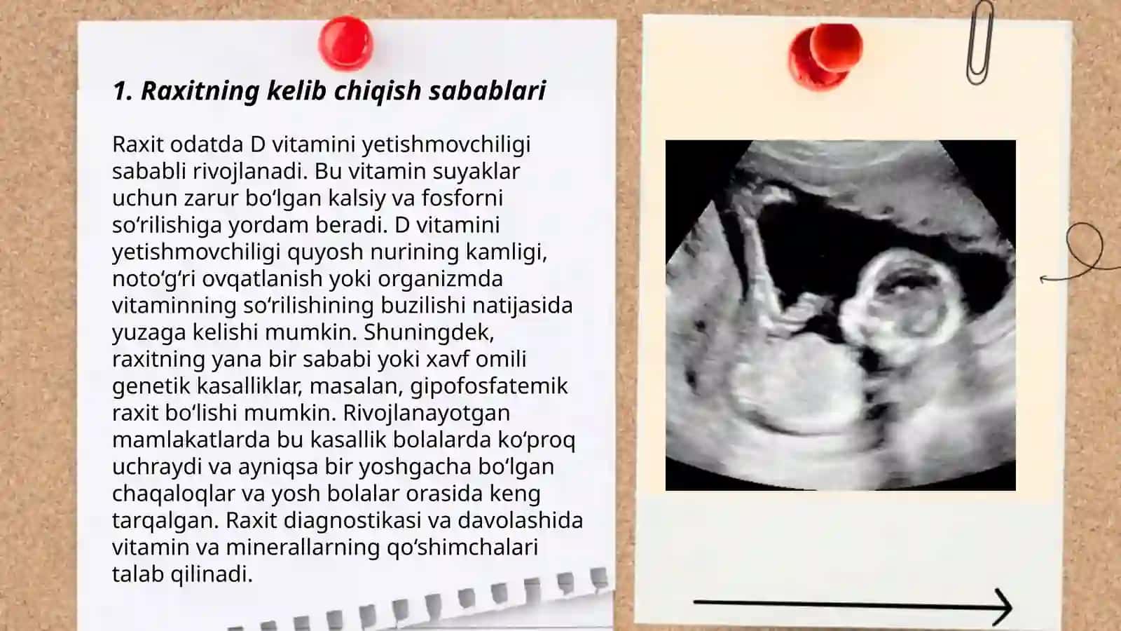 Raxitning bolalarda kelib chiqish sabablari 3