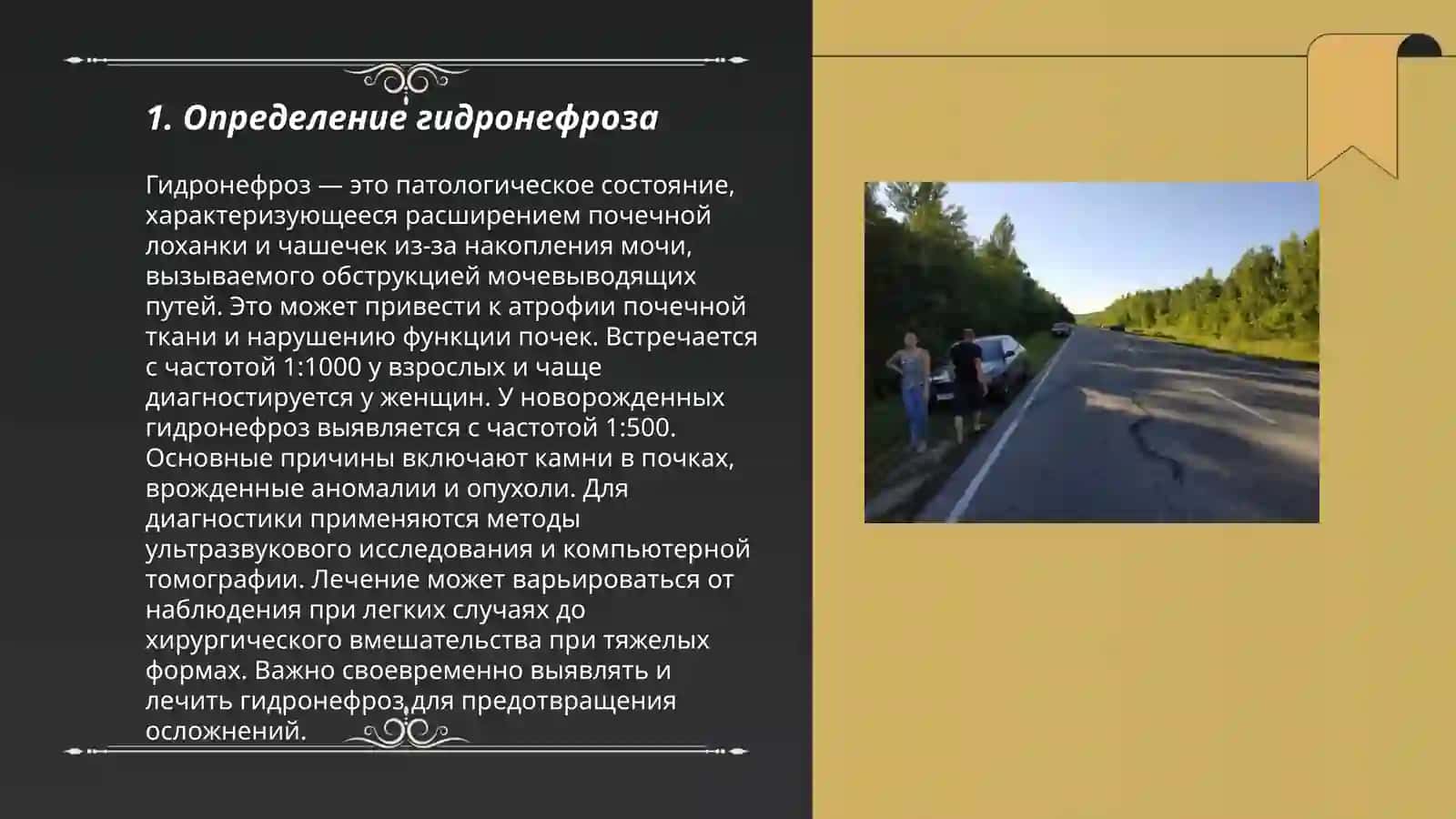 Гидронефроз 3