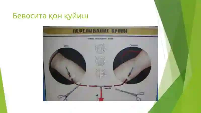 Қон қуйиш усуллари 3