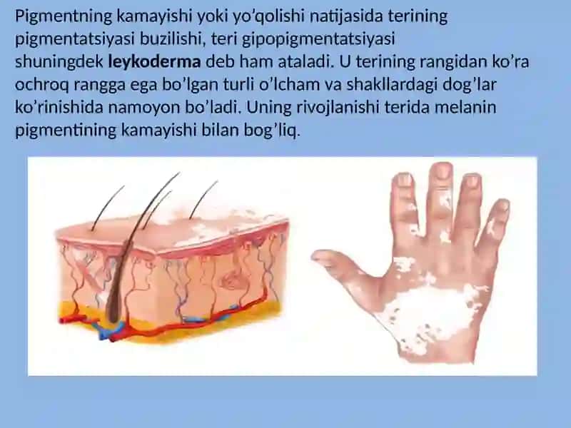 Leykoderma - teridagi oq dog’lar 3