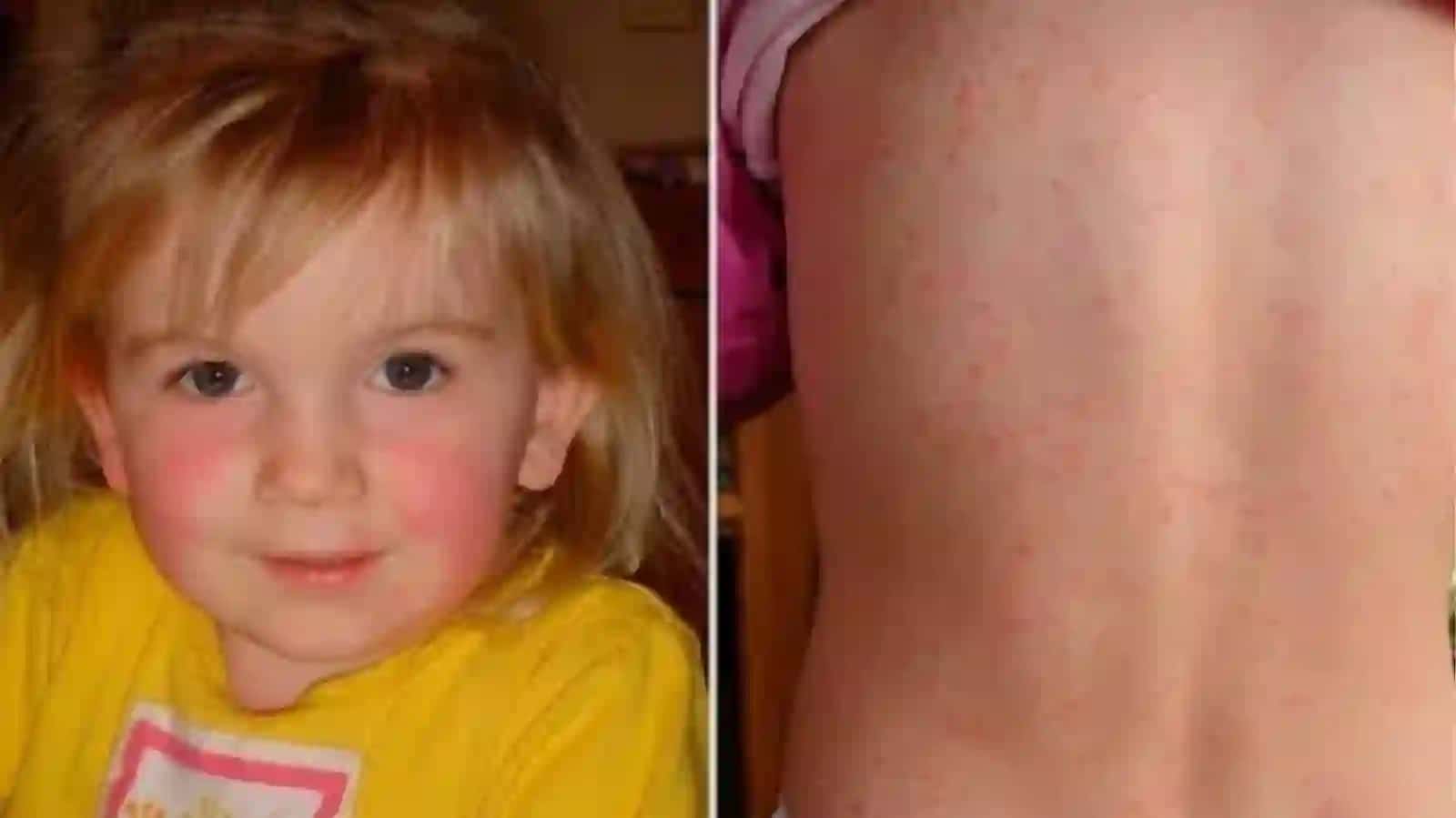Skarlatina: etiologiyasi, klinik belgilari, diagnostikasi va davolash — 16 slayd 3