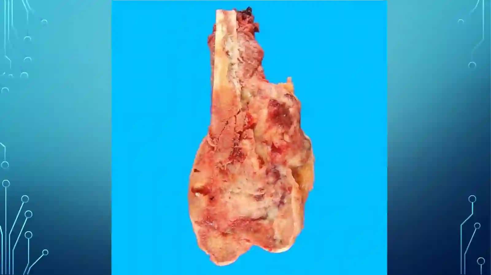 Osteosarkoma 3