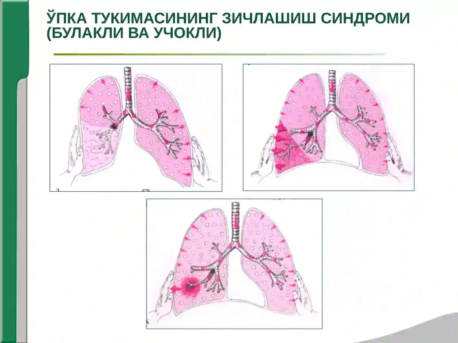НАФАС ОЛИШ ОРГАНИ  КАСАЛЛИКЛАРИНИНГ АСОСИЙ КЛИНИК СИНДРОМЛАРИ. УПКА ТУКИМАСИНИНГ ЗИЧЛАШИШ СИНДРОМИ, ПЛЕВРА БУШЛИГИГА ХАВО ВА СУЮКЛИК ТУПЛАНИШ СИНДРОМИ, УПКАДА БУШЛИК ХОСИЛ БУЛИШ СИНДРОМИ 3