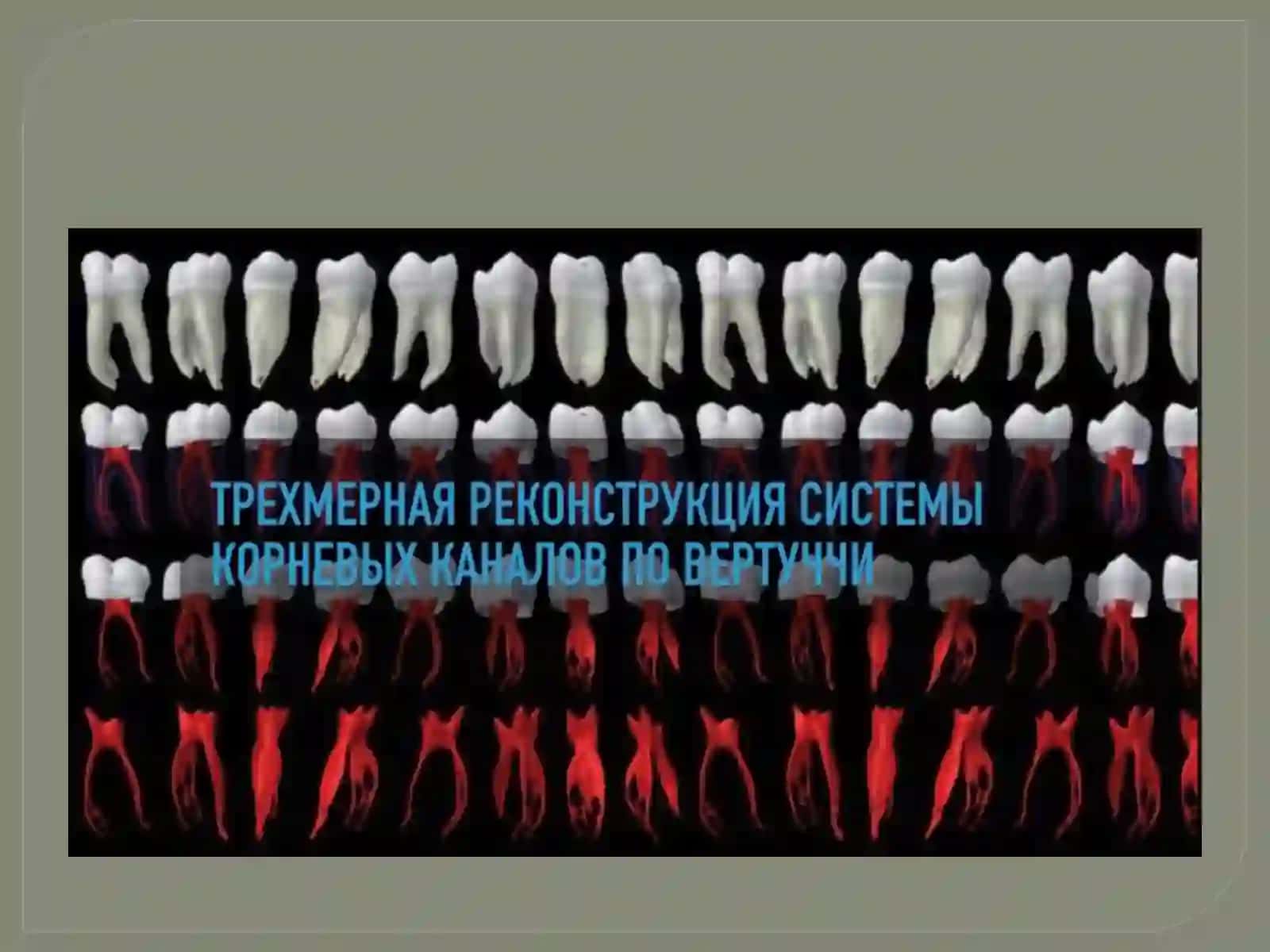 Crown down и Step Back методики расширения корневых каналов 3