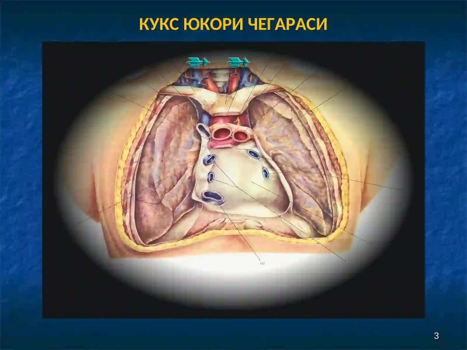 МЕДИАСТЕНИТ 3