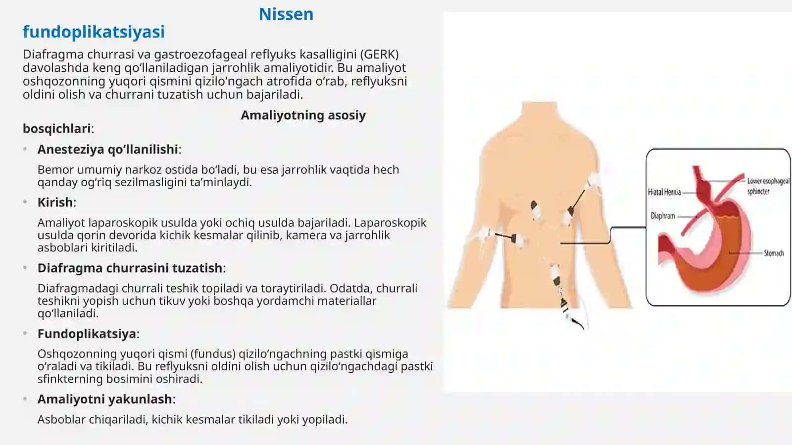Diafragma churrasida nissen bo'yicha fundoplikatsiya amaliyoti 3