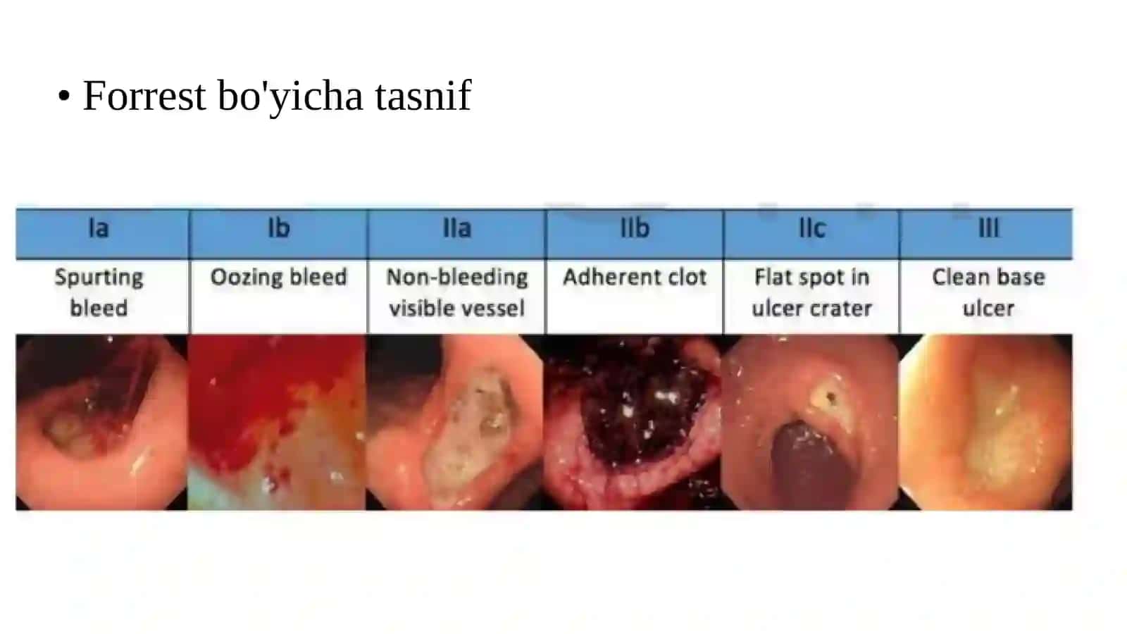 Oshqozon-ichak qon ketishlarini zamonaviy endoskopik davolash 3
