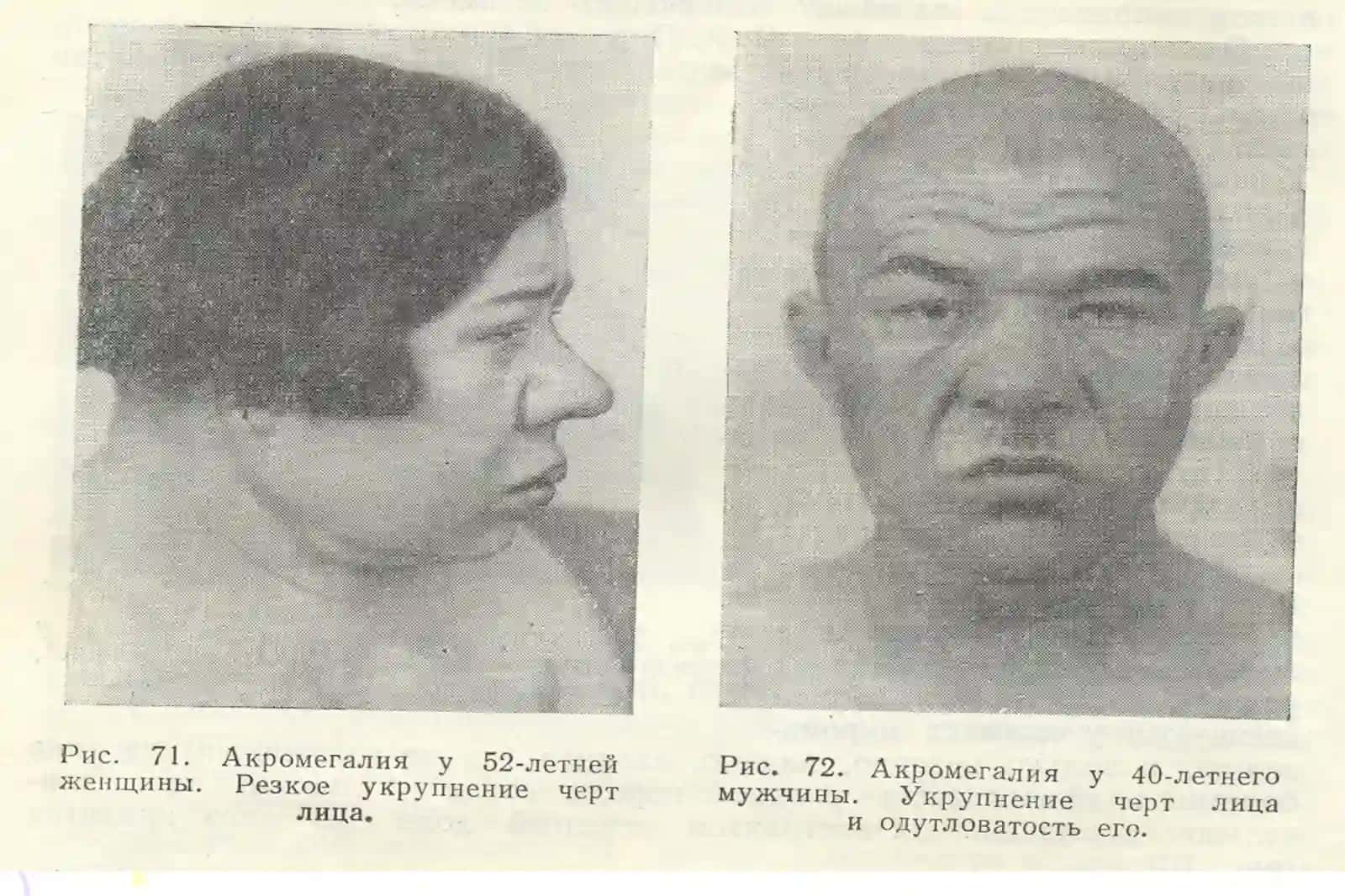 АКРОМЕГАЛИЯ 3