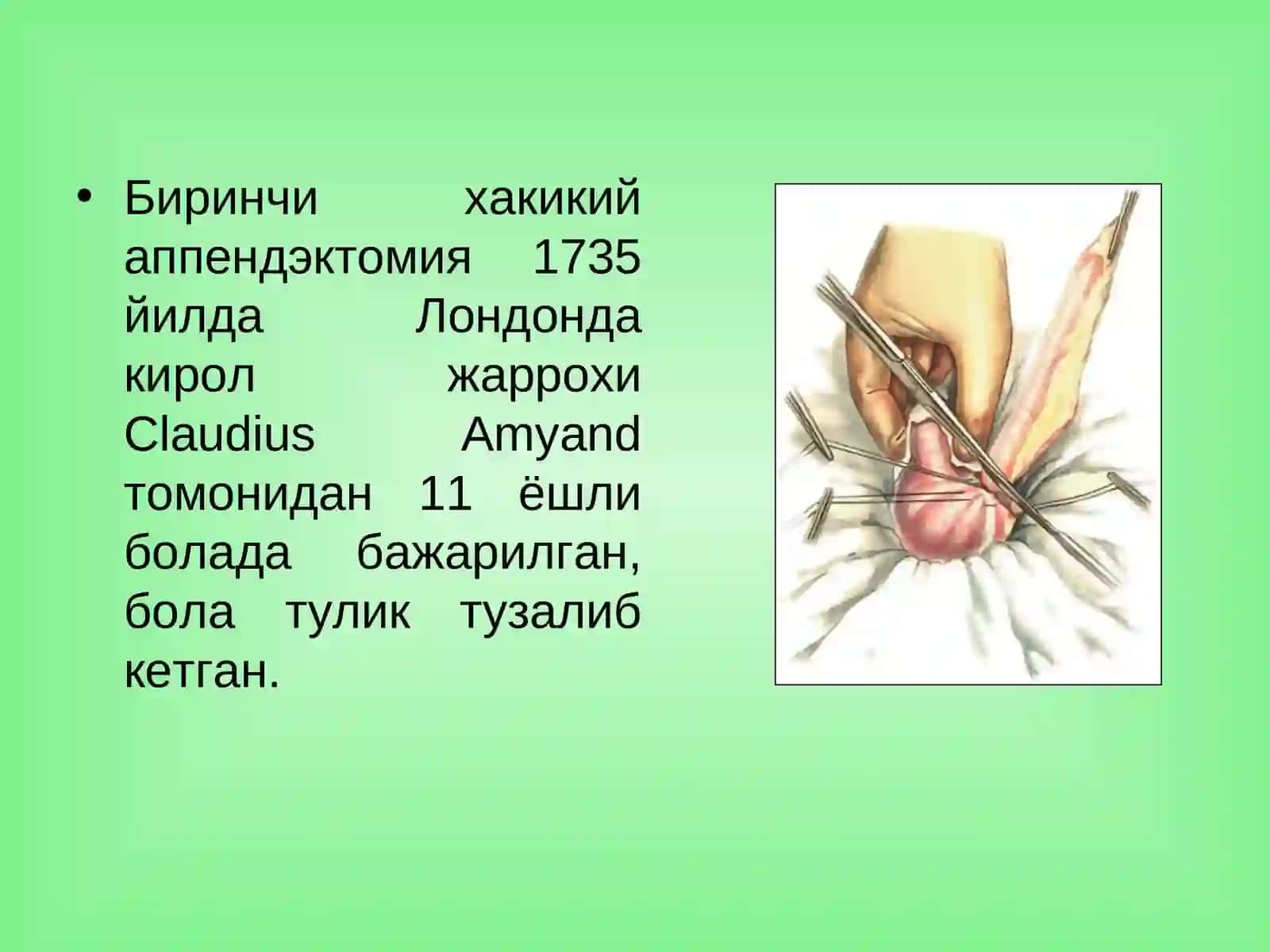 Oʻtkir apenditsit 3