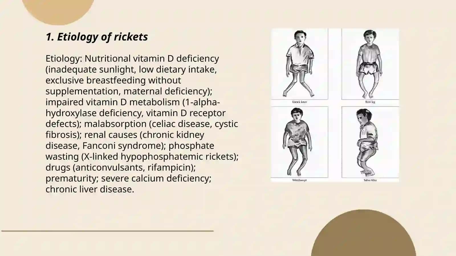 Rickets 3