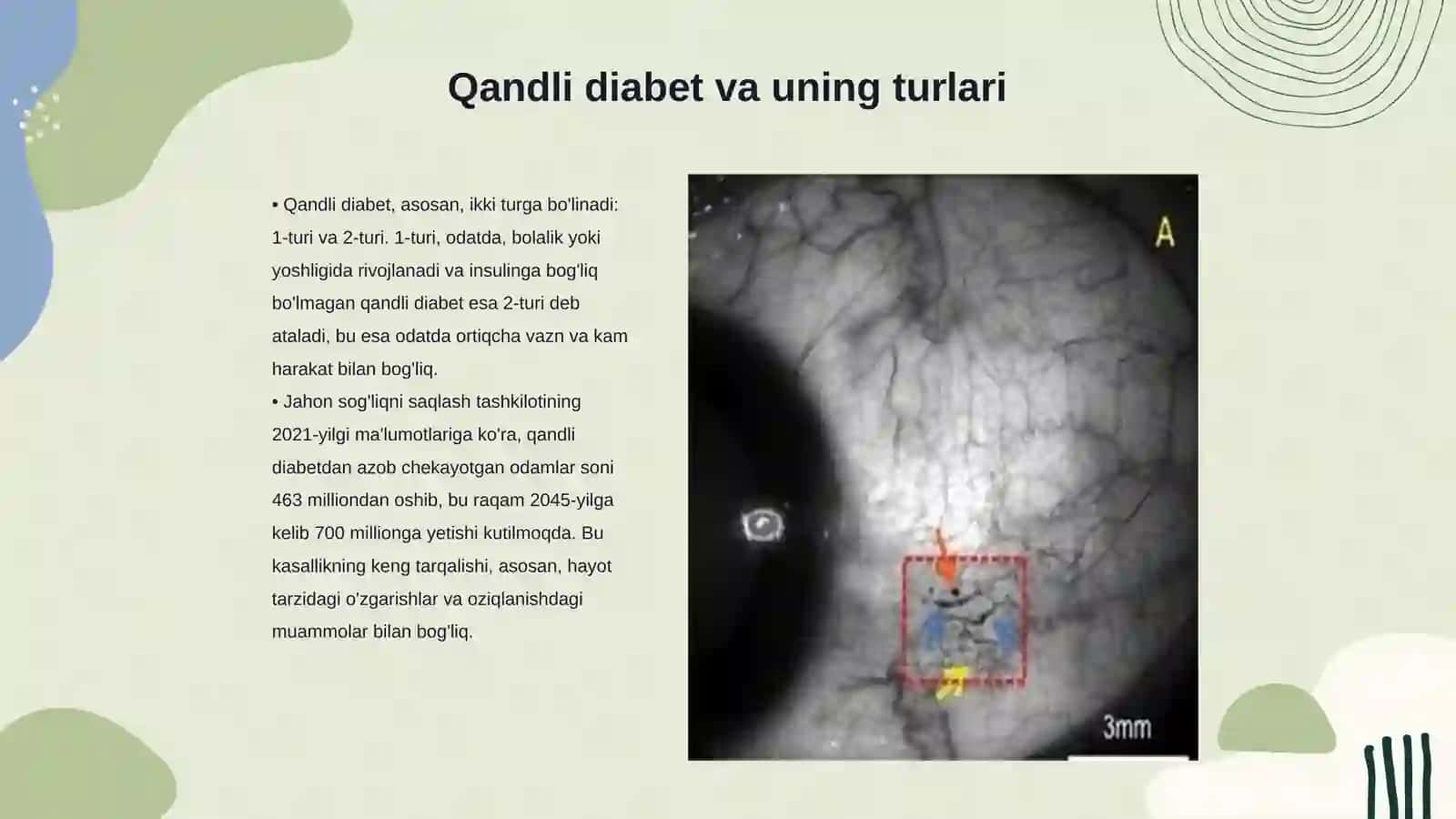 Qandli diabetning mikroangiopatiya nefropatiya turi 3
