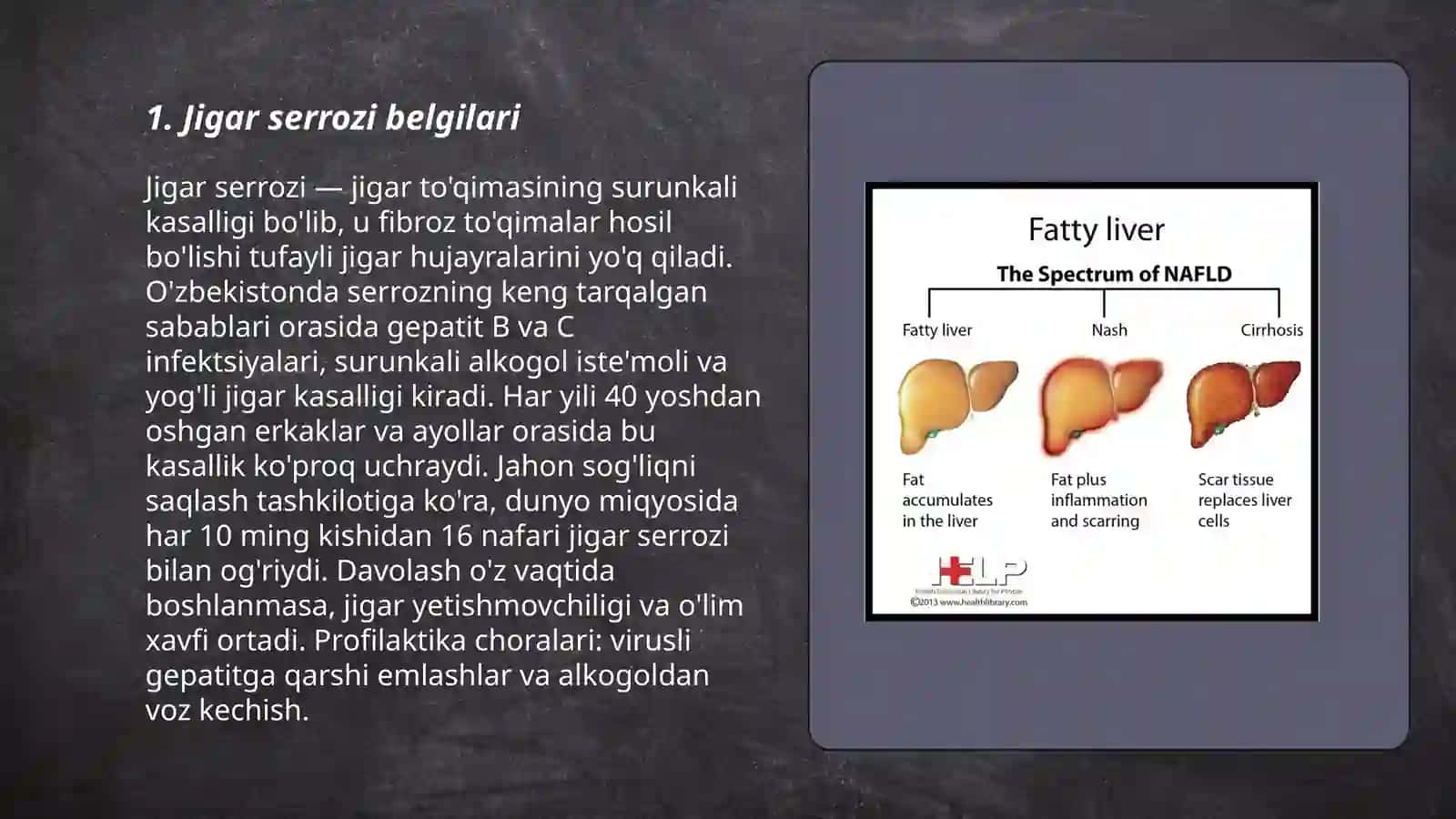 Jigar serrozi 3
