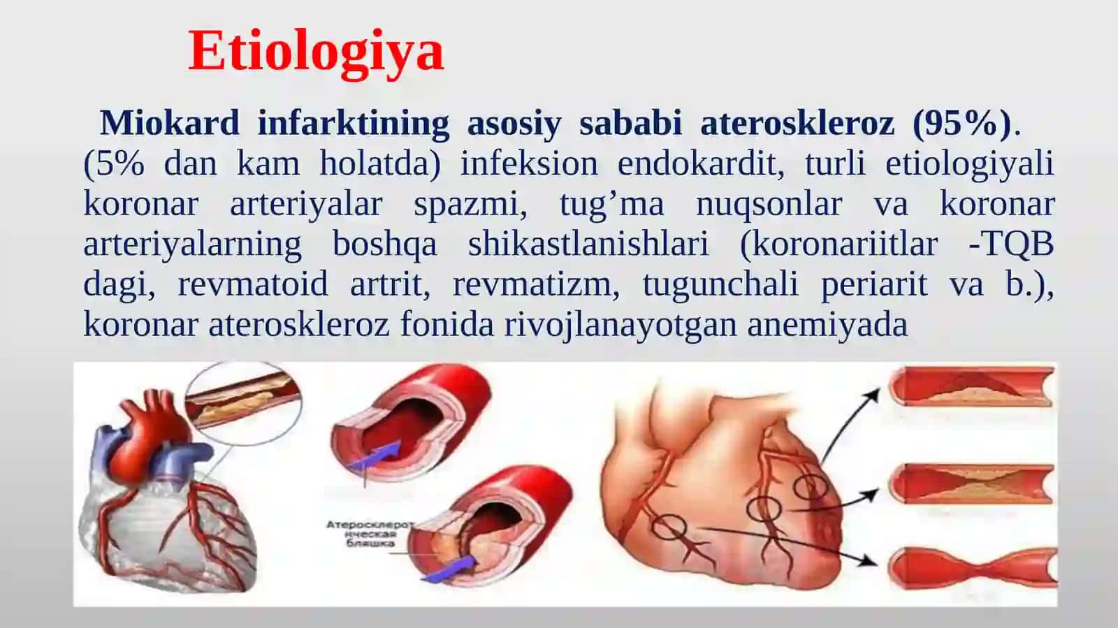 MIOKARD INFARKTI 3