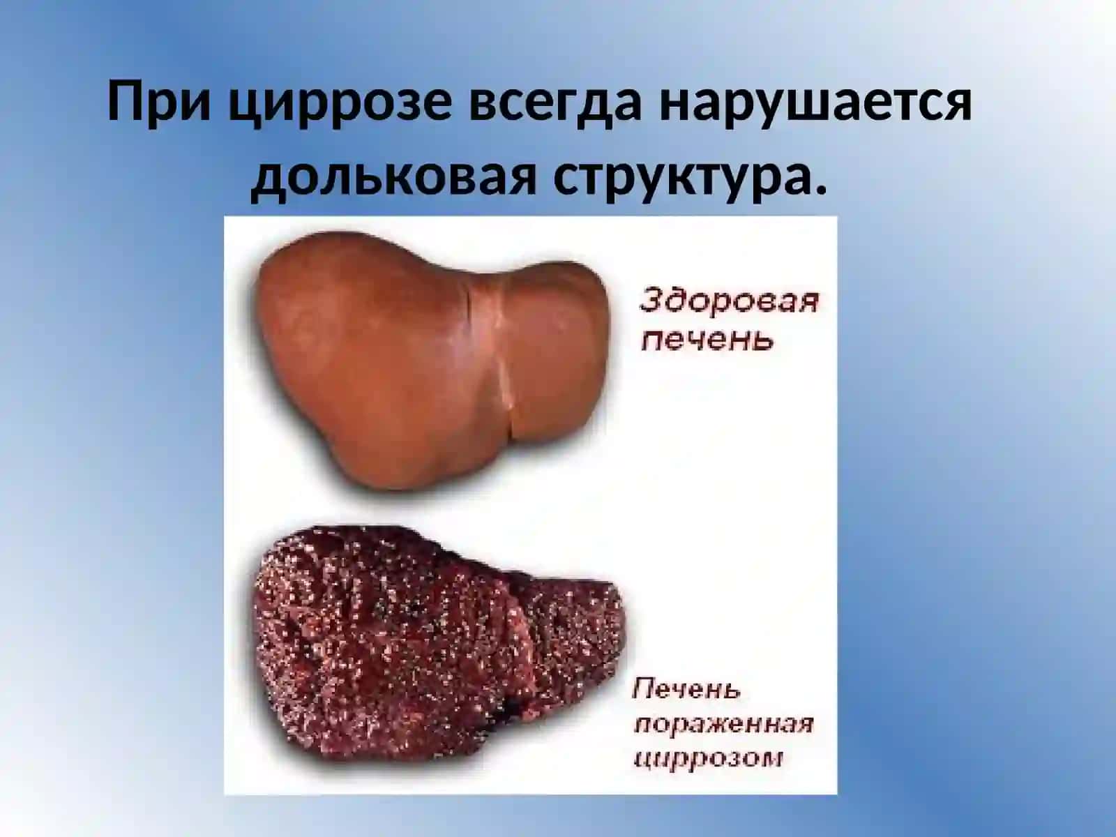 Цирроз печени 3