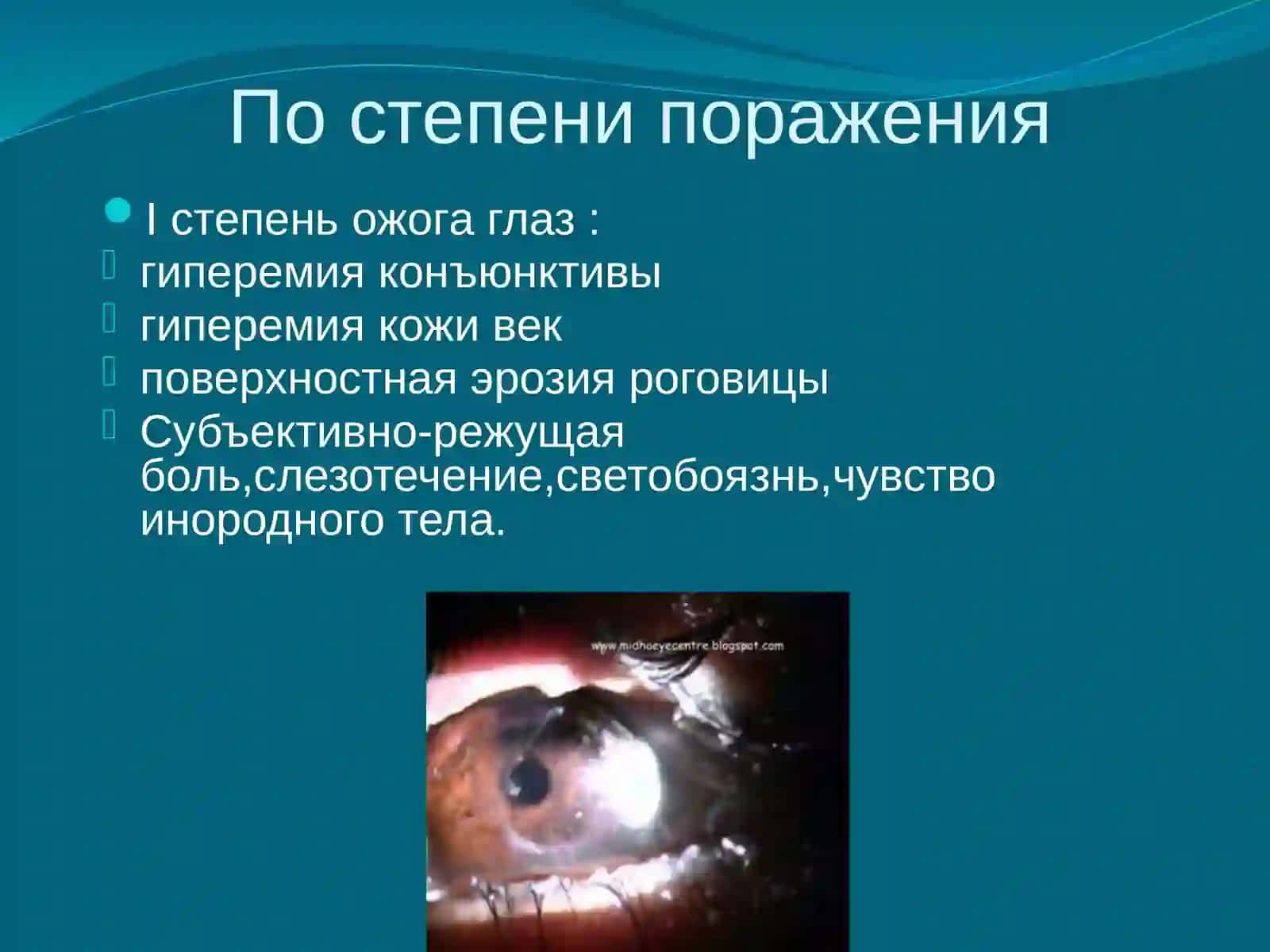 Ожоги глаз 3