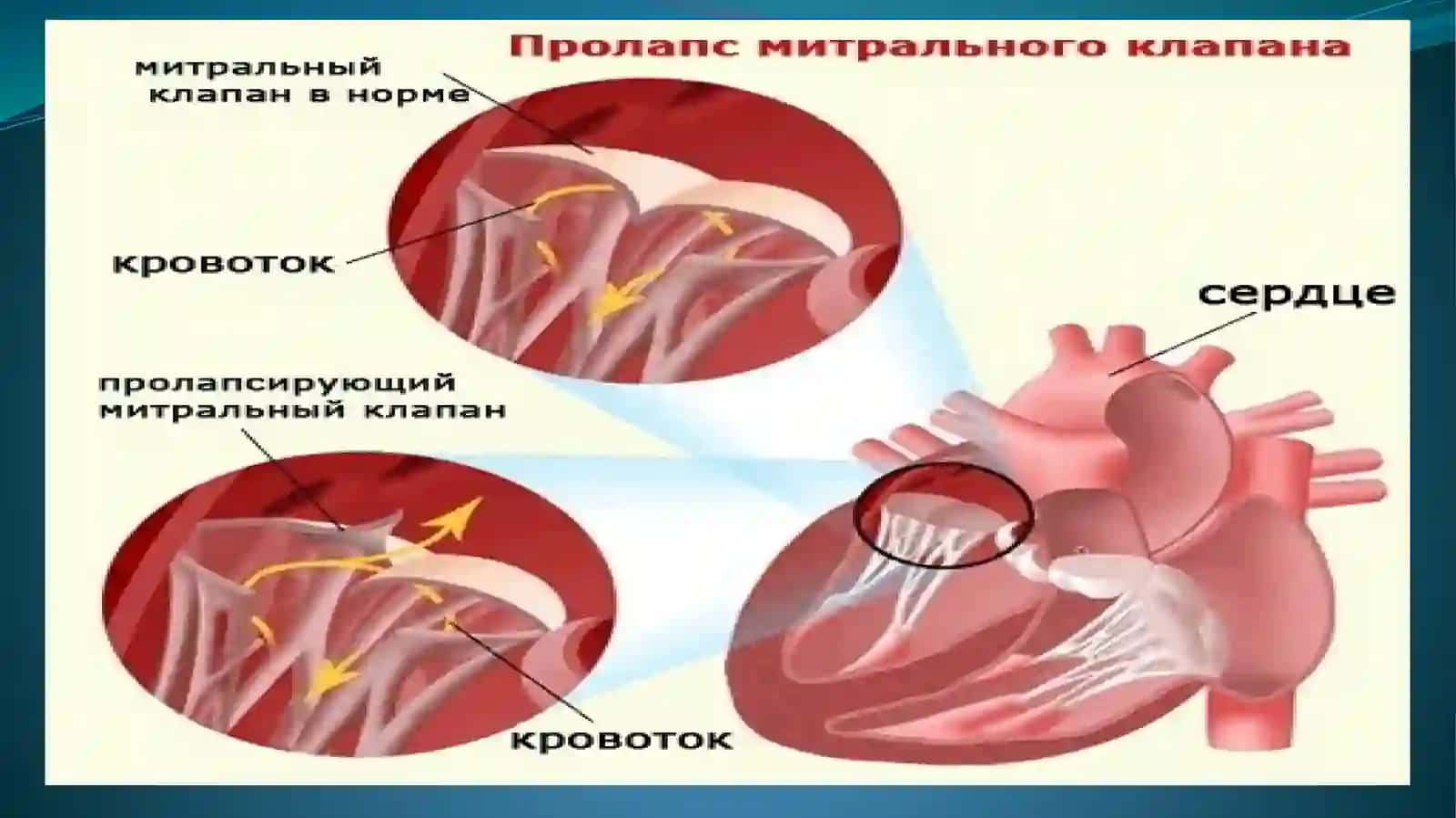 MITRAL KLAPAN PROLAPSI 3