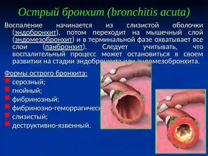 Острый бронхит (bronchitis acuta) 3