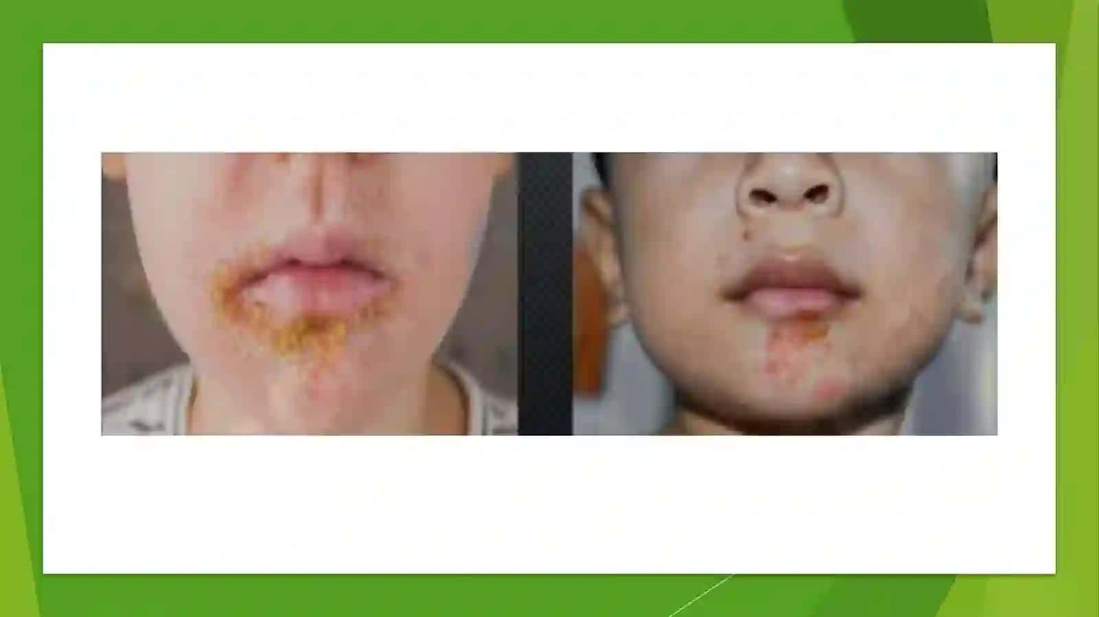 Yiringlipiodermiyasi 3