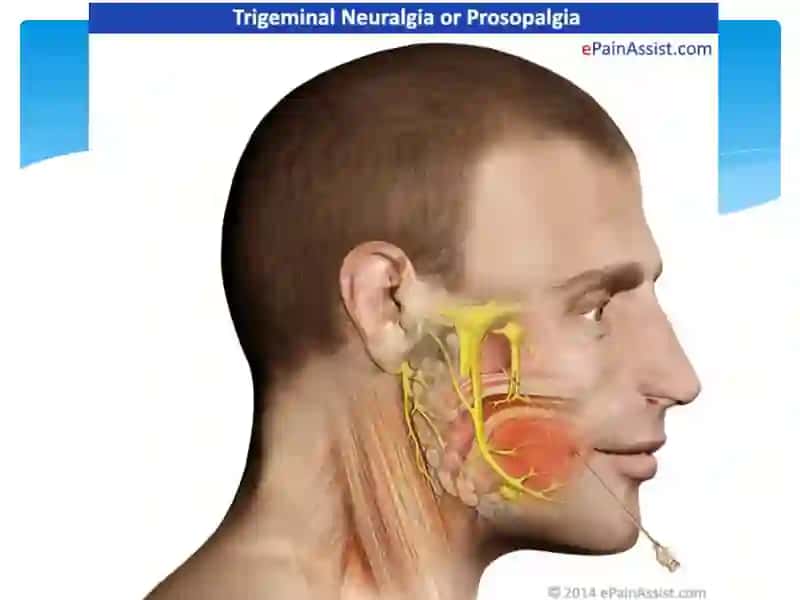 Prozopalgiyalar 3