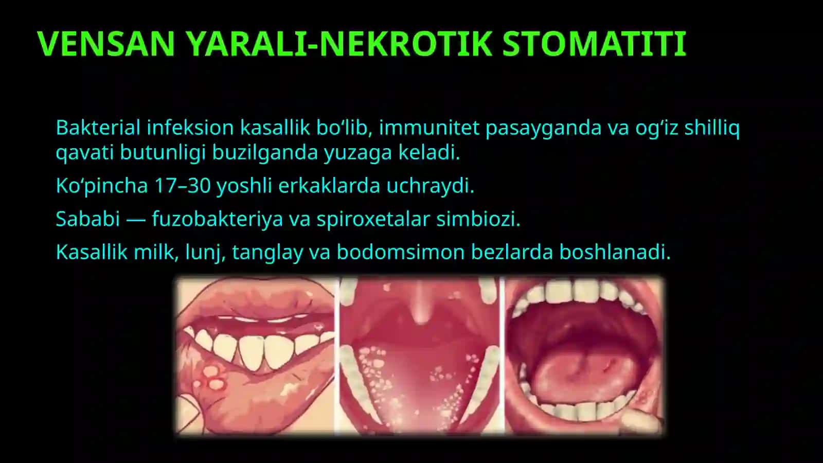 Yarali-nekrotik stomatit Vensan. Klinika. Davolash. 3