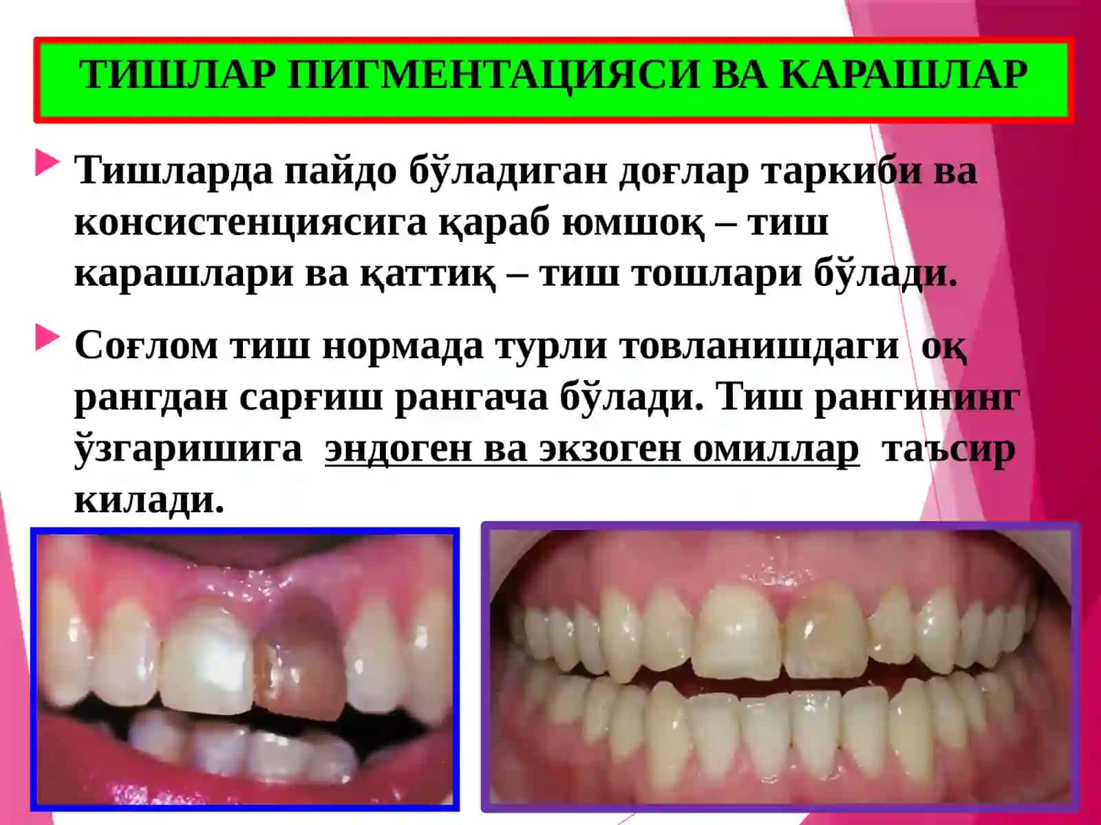 Тиш чиққандан сўнг ривожланадиган нокариес касалликлар.Этиологияси,патогенези,таснифи,клиникаси,ташхислашвақиесий ташхиси,даволашвапрофилактикаси 3