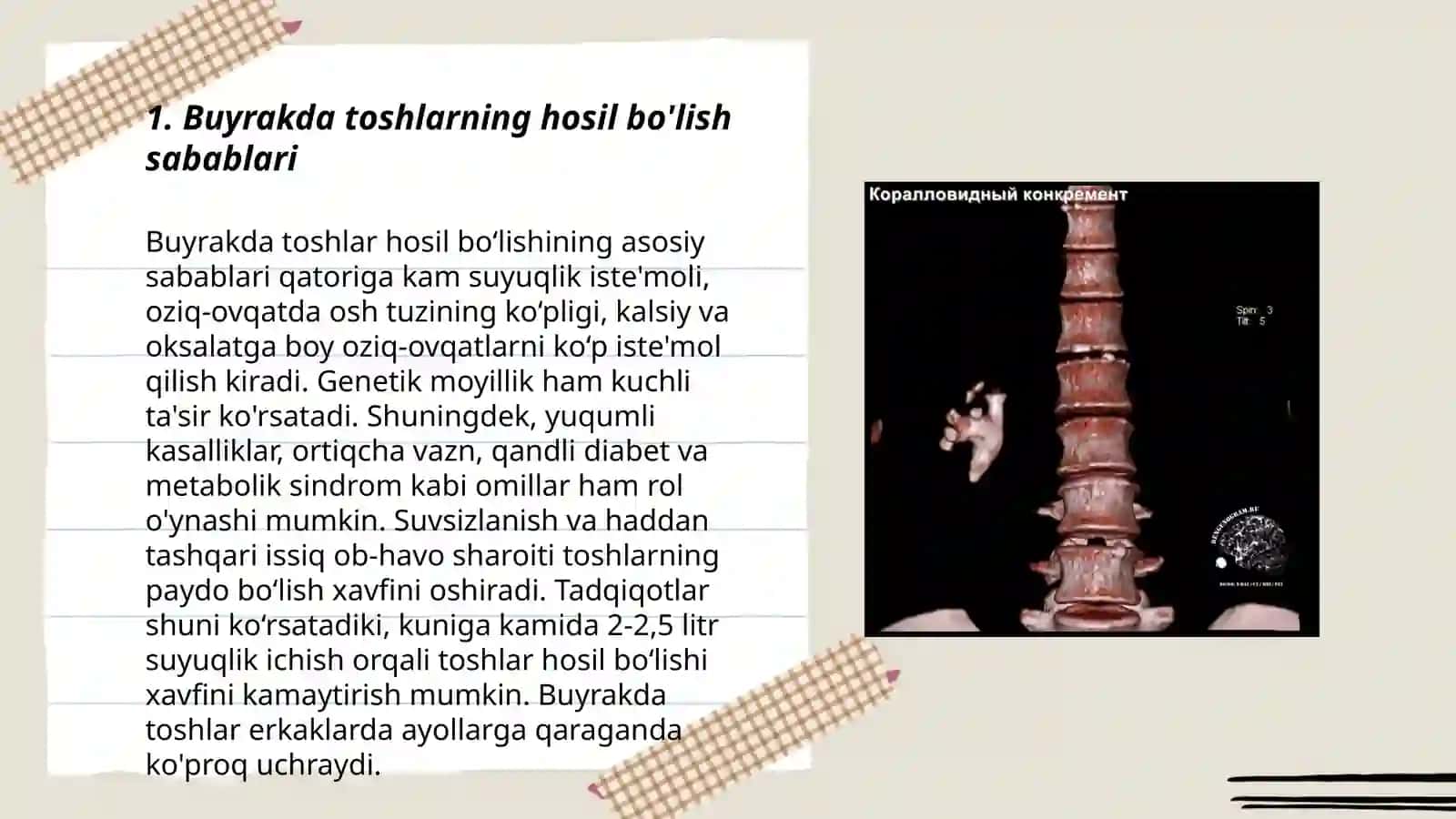 Buyrakda toshlarini hosil bo'lishi va davolash yollari 3