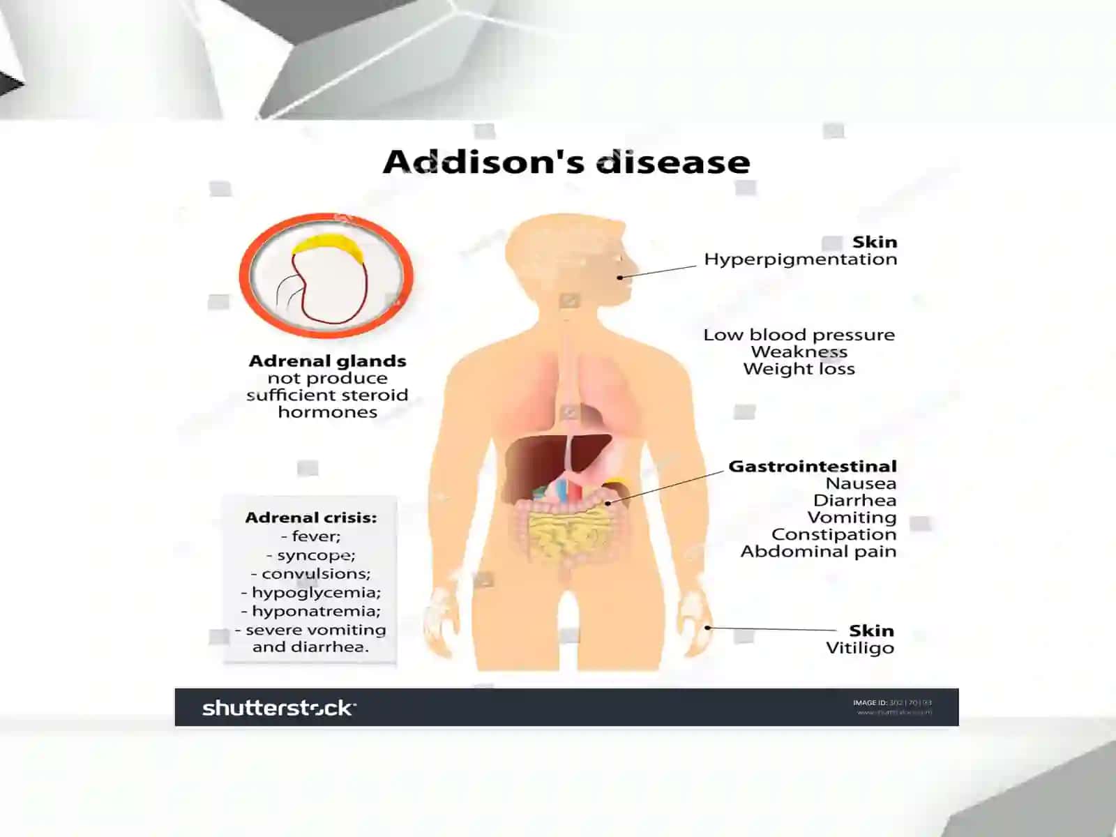 Addisonik kriz 3