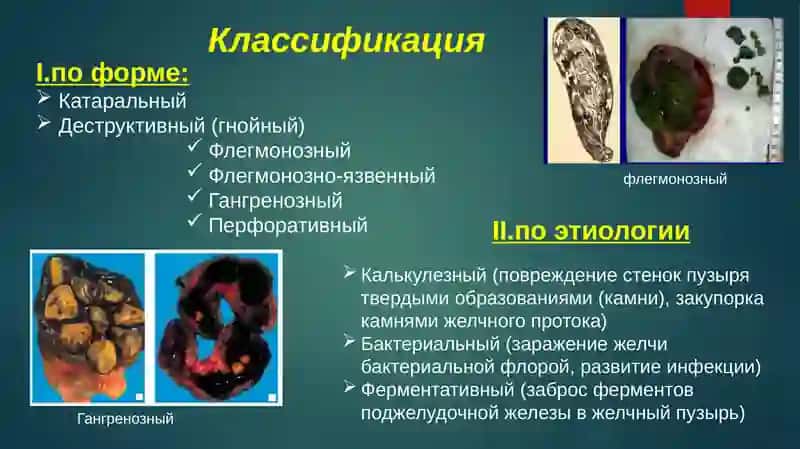 Холецистит 3