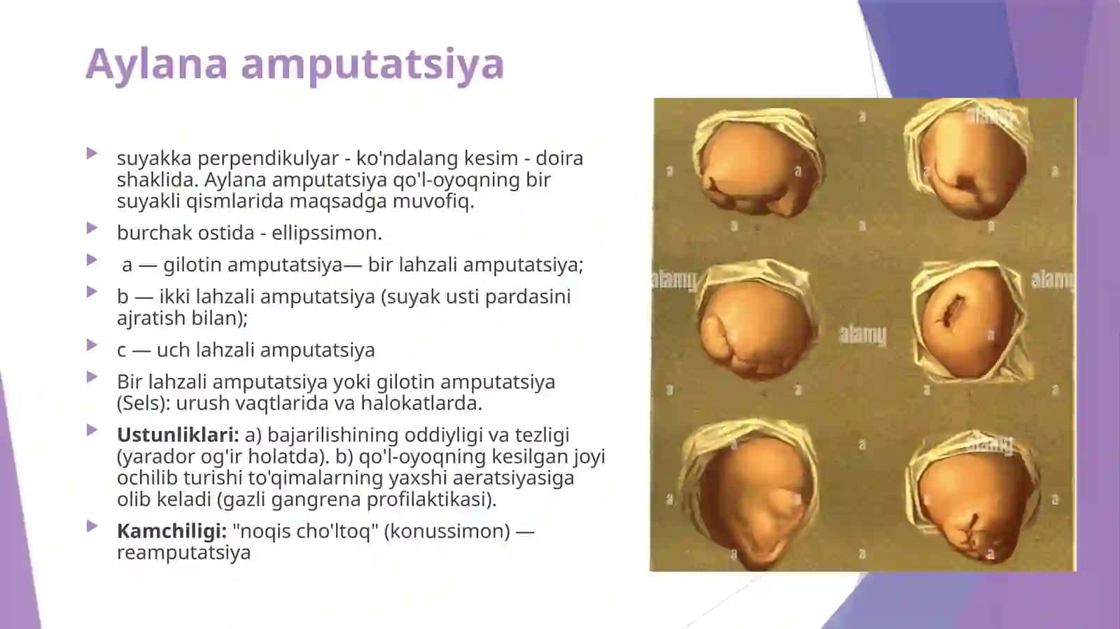 Qo‘l va oyoq amputatsiyalari va ekzartikulatsiyalari. Qo‘l va oyoq suyaklaridagi operatsiyalar 3