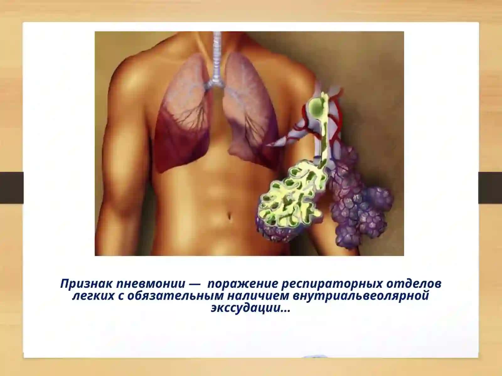 ПНЕВМОНИЯ 3