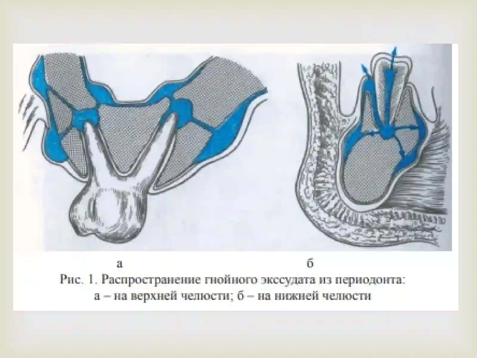 Periodontitlarni tekshirish natijalariga ko‘ra tashxislash va xirurgik davolash usullariga ko‘rsatma va qarshi ko‘rsatmalarni aniqlash. Periodontitlarni xirurgik davolashda tish saqlovchi operatsiyalar 3