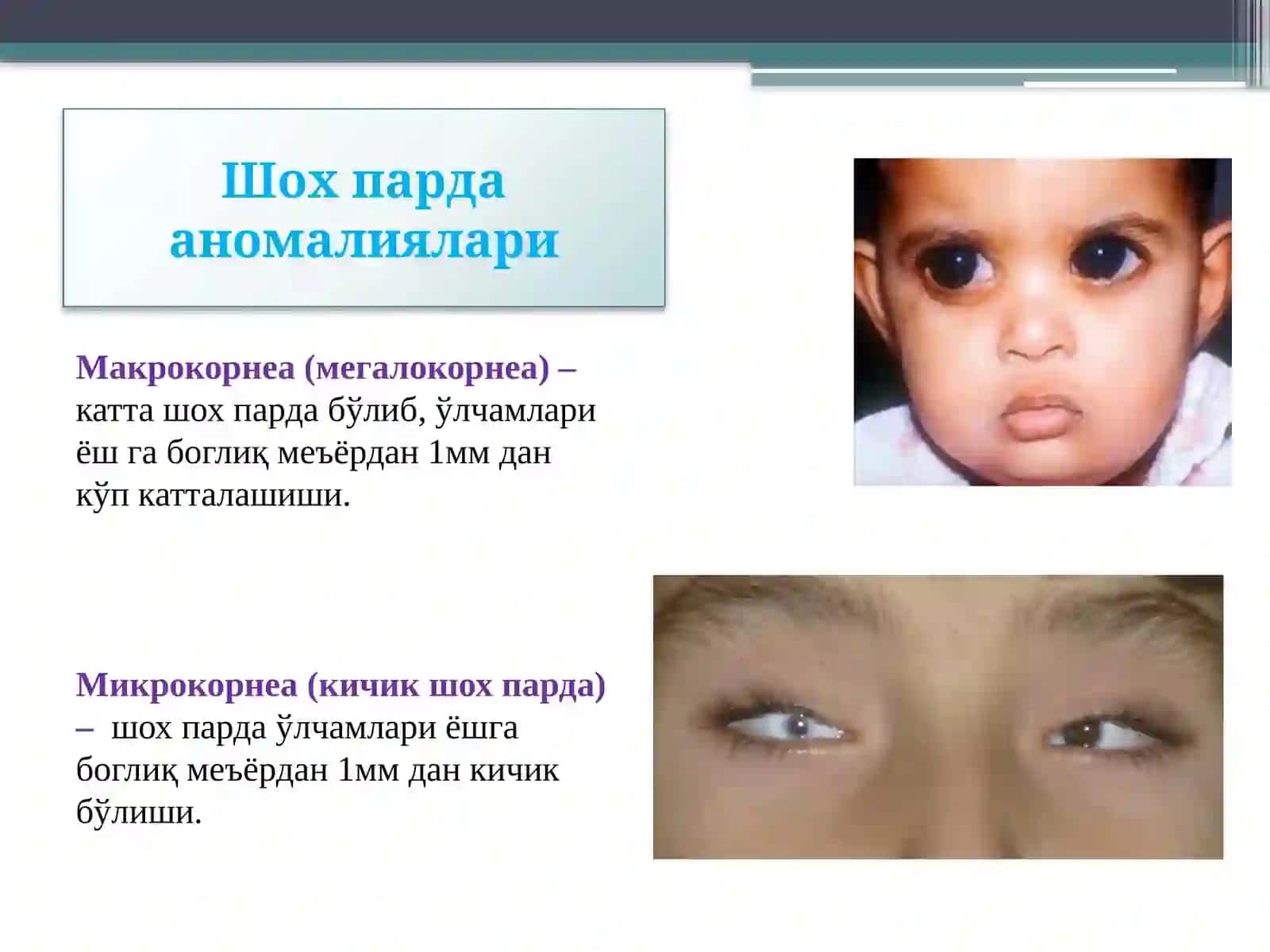 Шох парда касалликларининг, этиология ва патогенези, аномалияларивакератитларнидиагностикасивадавоси 3