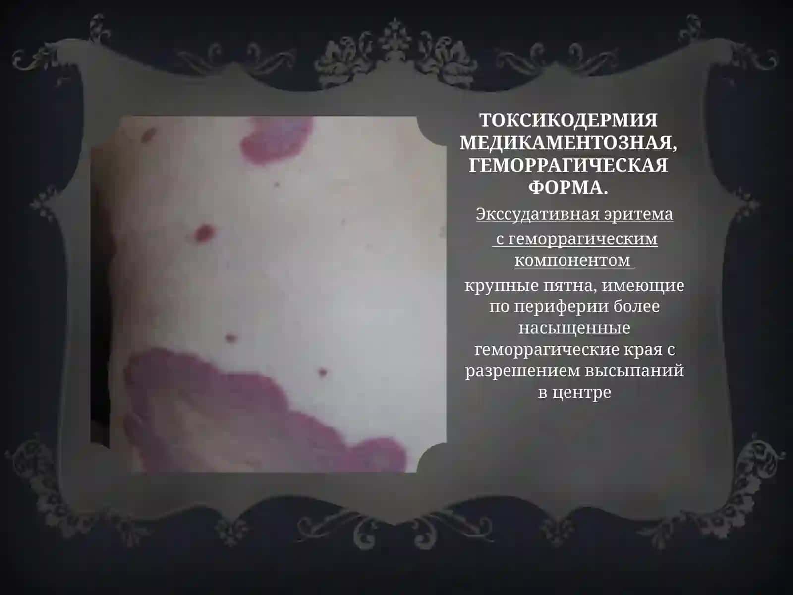 Токсикодермия 3