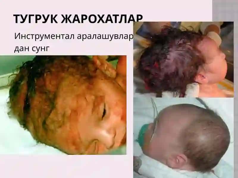 Бош миянинг тугруқ жарохатлари.Перинатал энцефалопатия. Бош мияга қон қуйилиш 3