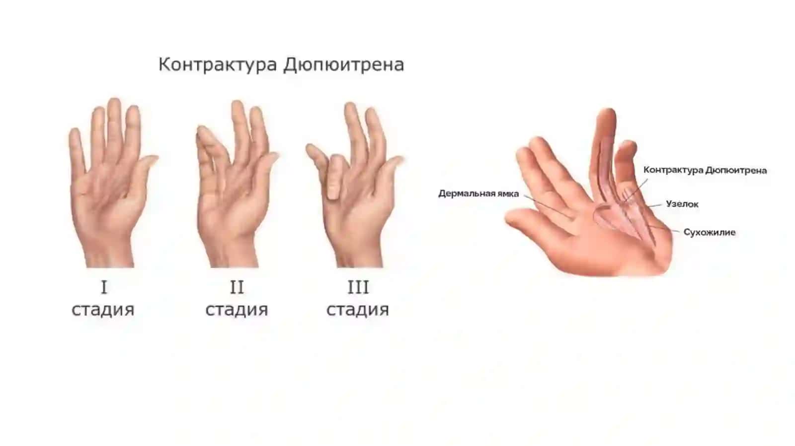 Dyupyuitren kontrakturasi 3