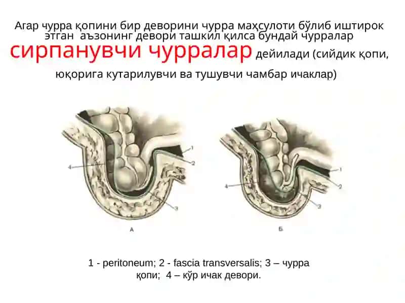 Қоринолди девори тўғри мушаклар диатези 3
