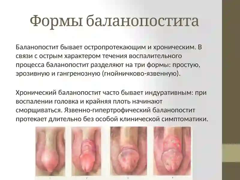 Баланопостит 3