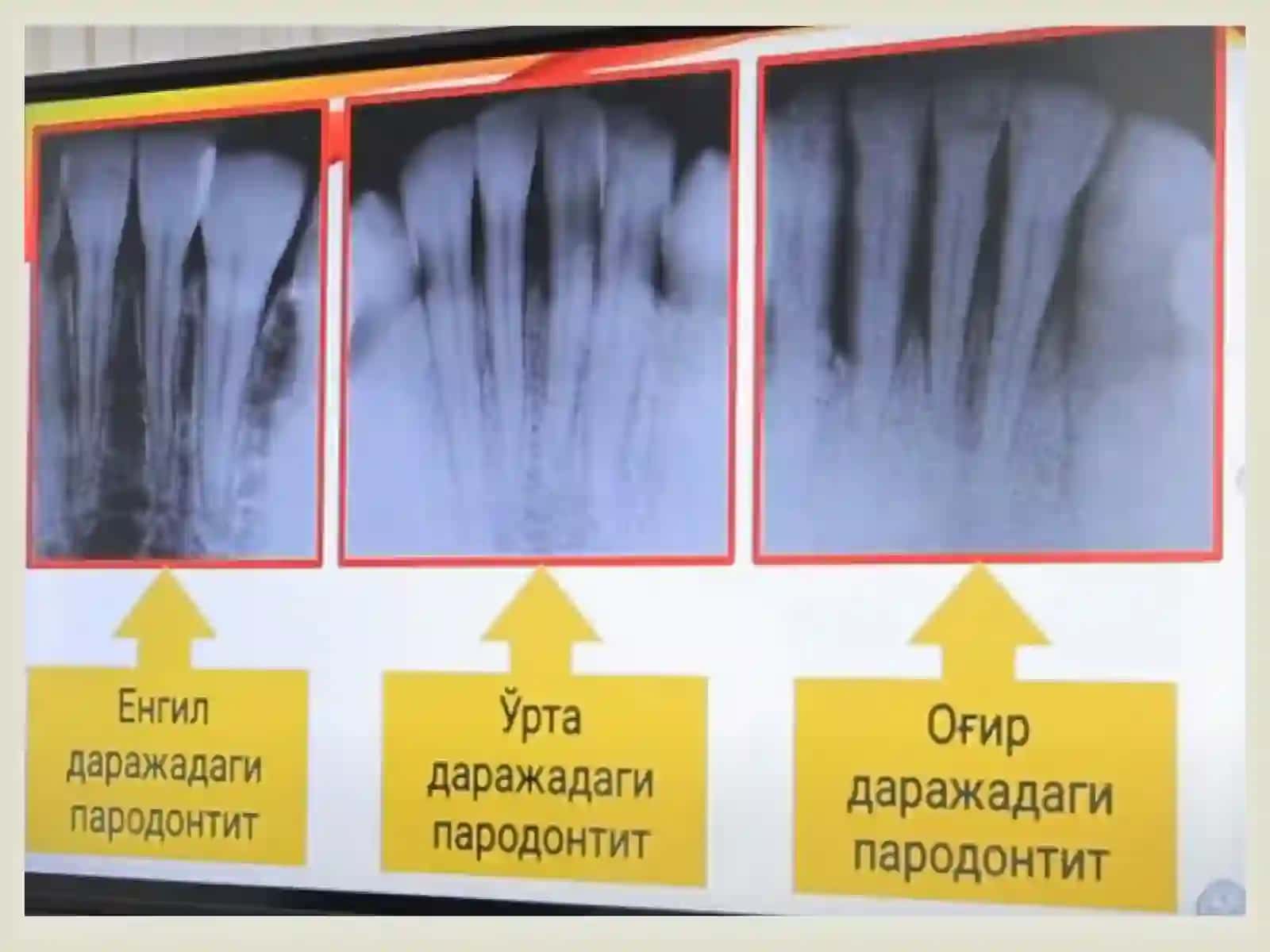 Parodontit. O’rta va og’ir shakllari. Klinikasi,diagnostikasi, qiyosiy tashxisi. Kasallik tarixini yozish. 3