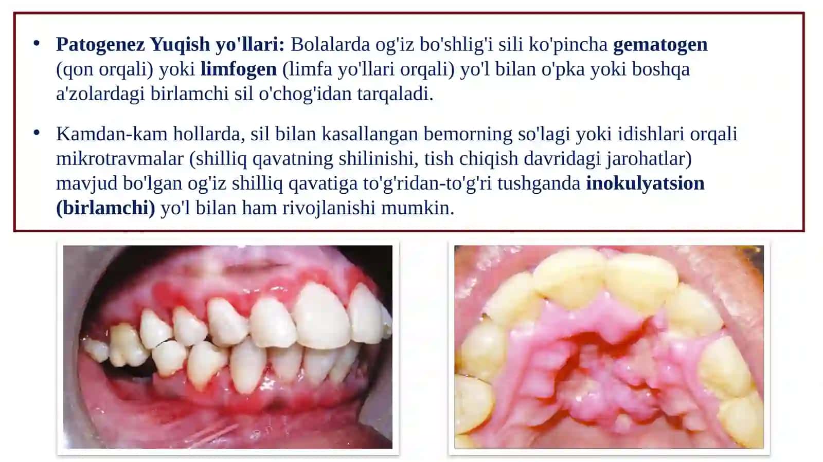 BOLALAR YOSHIDAGI OG‘IZ BO‘SHLIG‘I SHILLIQ QAVATIDA SIL VA ZAXM KASALLIKLARIDAGI O'ZGARISHLAR, KLINIK KECHISHI, TASHXISI VA DAVOSI 3