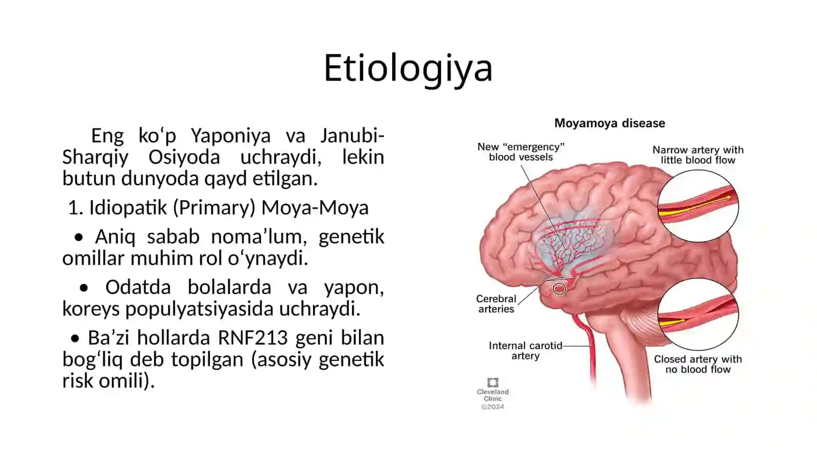 Moya-moyakasalligi 3