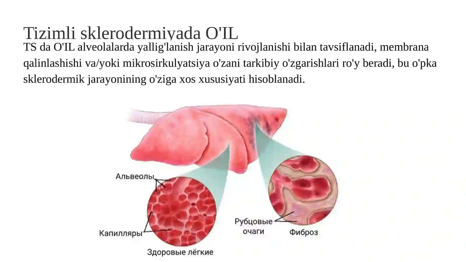 Sklerodermiyada o'pka interstitsial zararlanishi (2-variant) 3