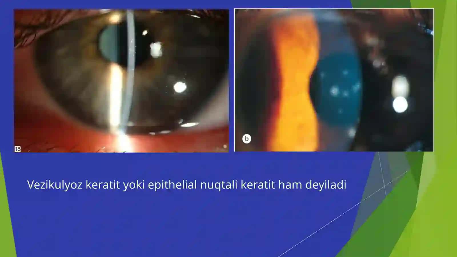 Gerpetik keratitlar 3