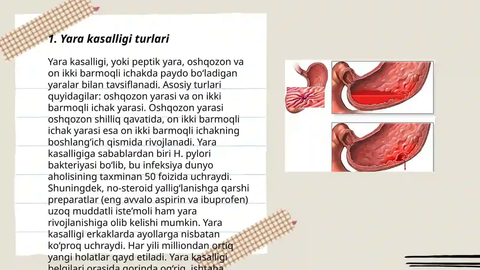 Oʼn ikki barmoqli ichak va oshqozon yara kasalliklari 3