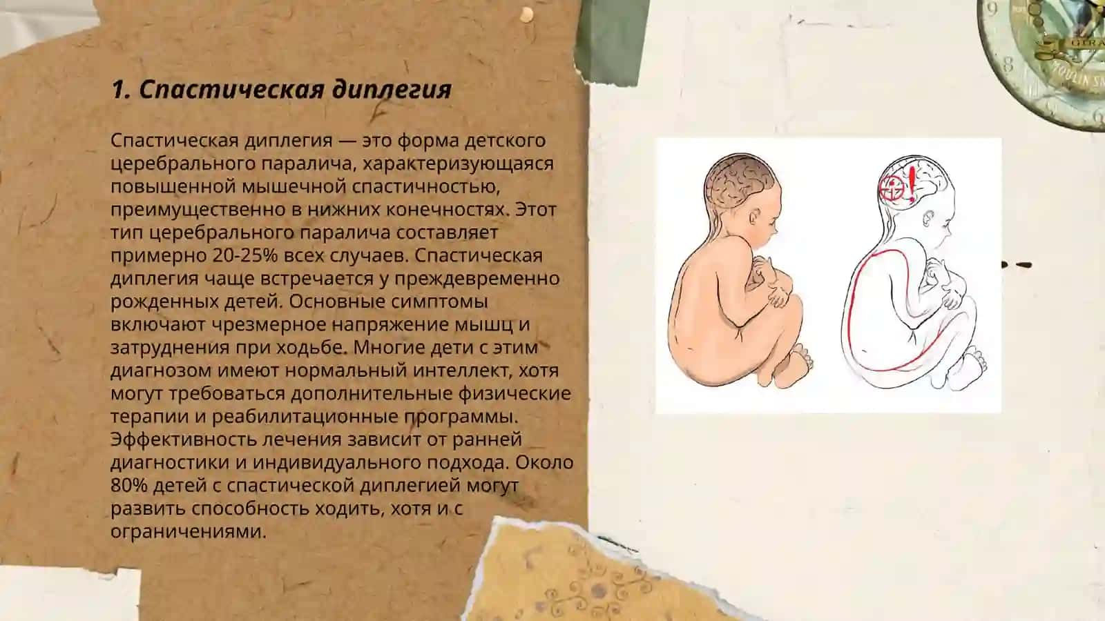 Клинические формы детского церебрального паралича 3
