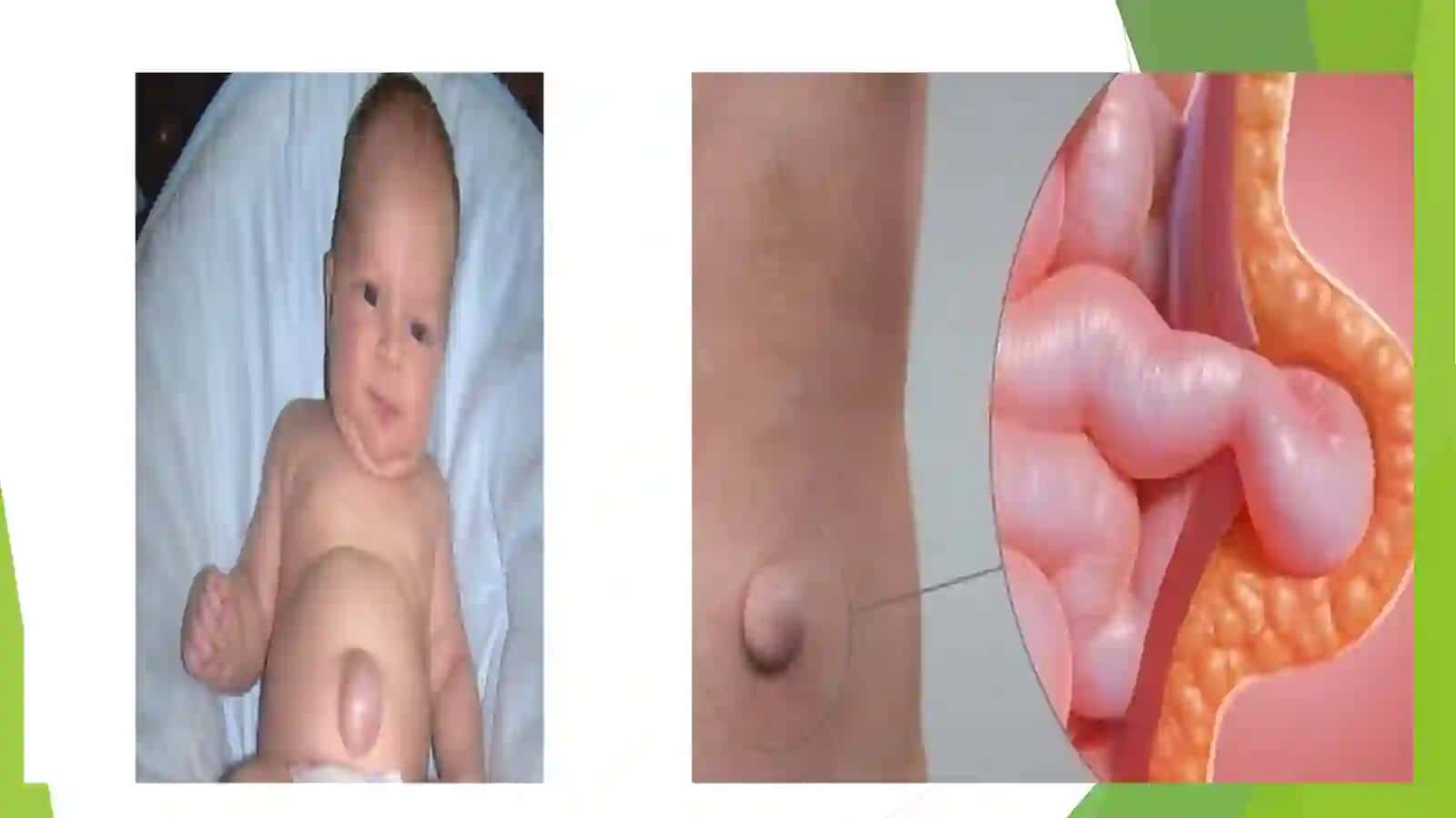 Kindik tizimchasi churrasi 3