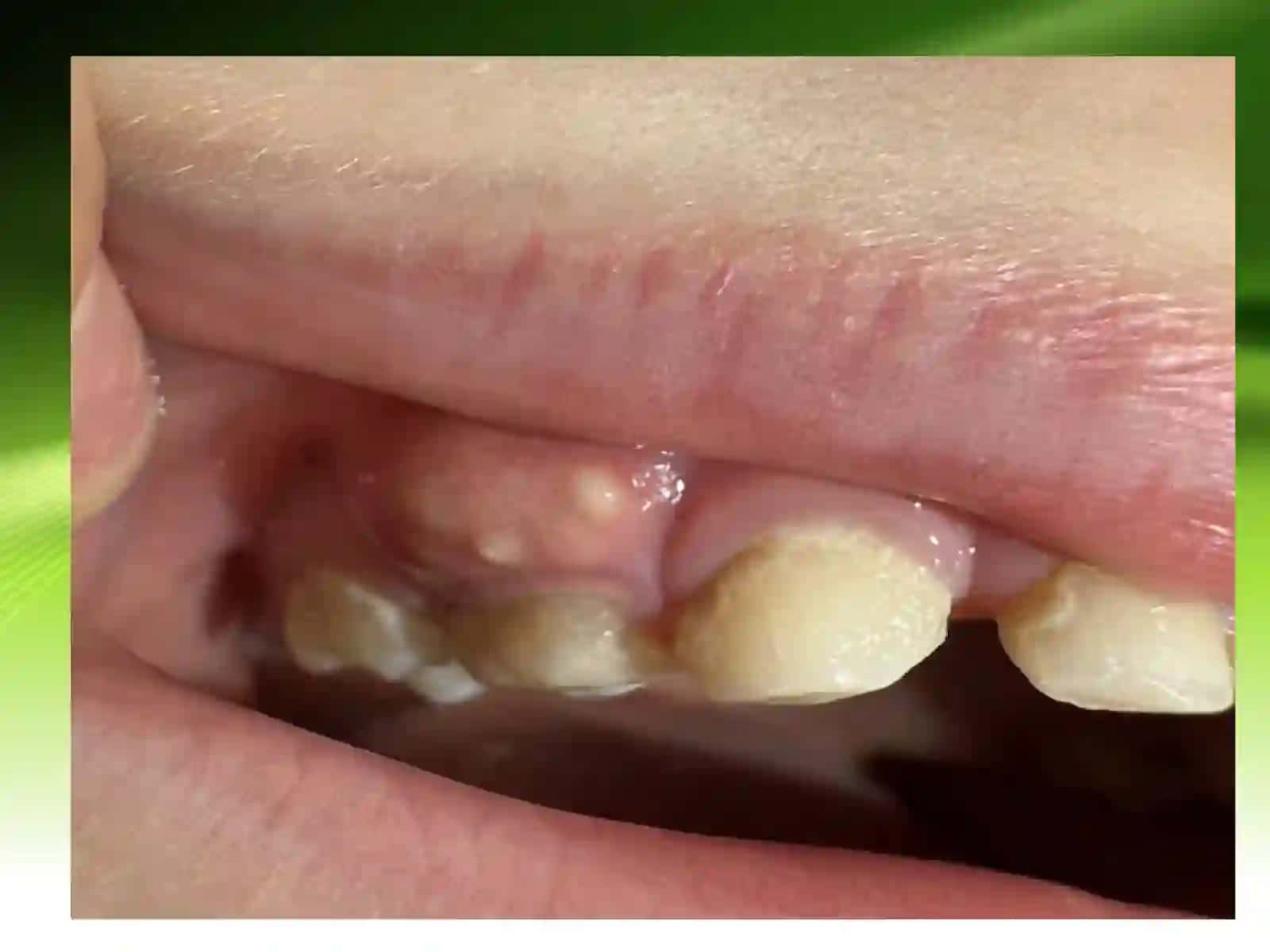 Sut tishlari va periodantit. Endodontik plomba ashyolari 3
