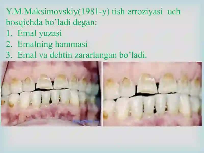 Tish chiqqandan keyin paydo bo’ladigan nokariyes kasalliklar. Tish qattiq  to’qimasi eroziyasi. Klinikasi, tashxislash va qiyosiy tashxislash. 3