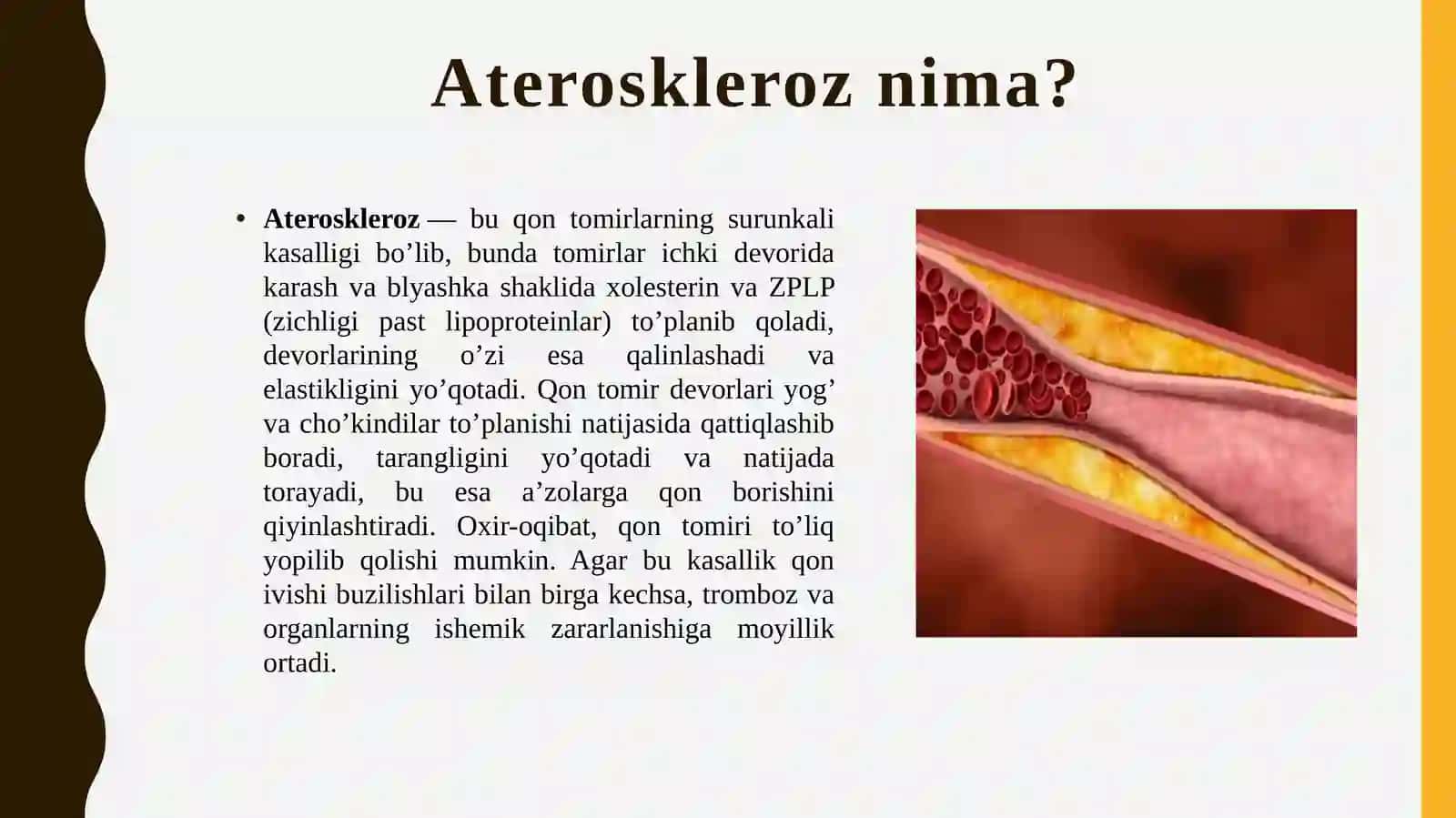 Ateroskleroz  kasalligi  haqida  tushuncha 3