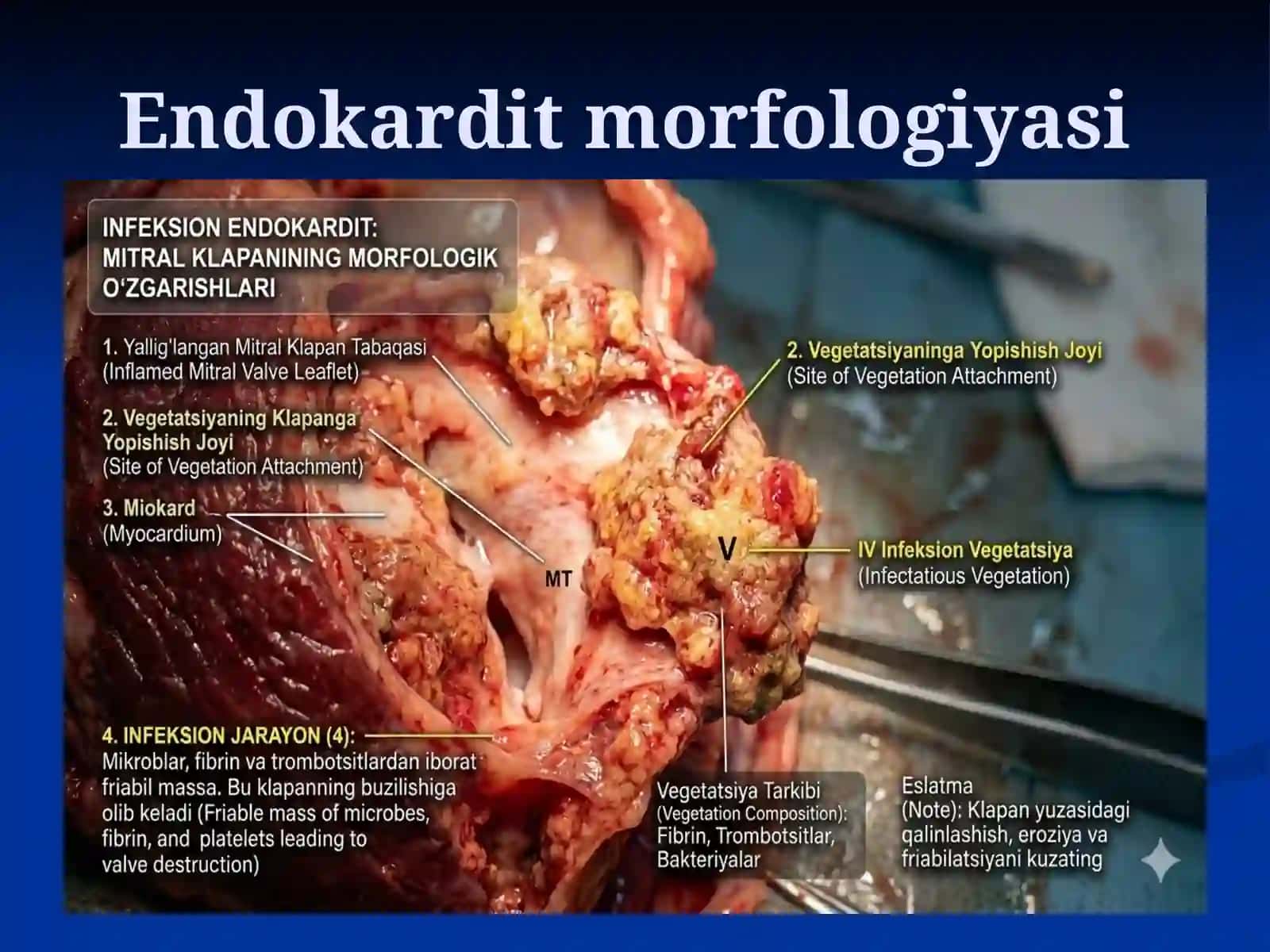 INFEKSION ENDOKARDIT PREZENTATSIYA 3
